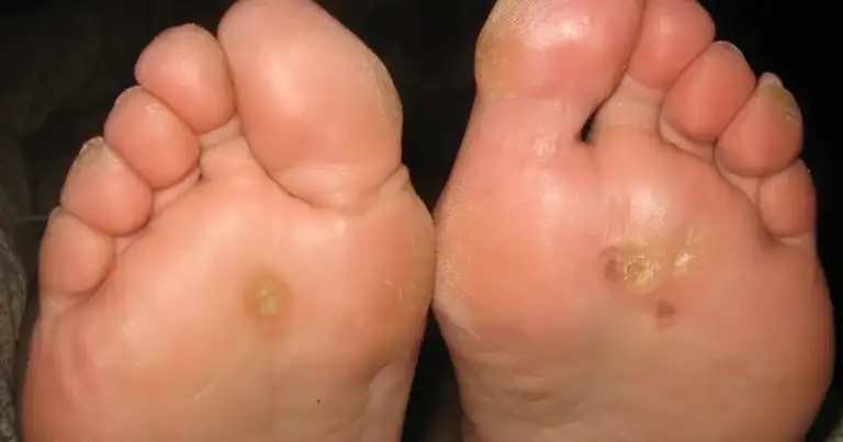 Foot warts aren't ugly; they're a serious health risk.